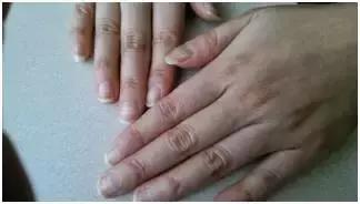 指甲变色变厚怎么处理,指甲变色了怎么办