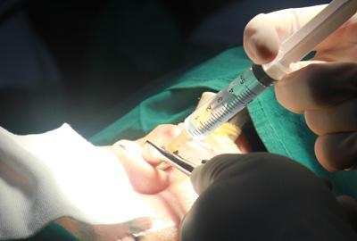 有谁做过达拉斯隆鼻,达拉斯隆鼻区别