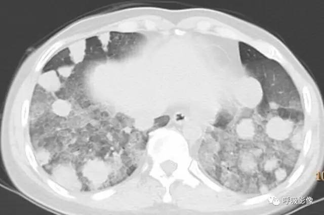 绒毛膜癌转移到脑,绒毛膜癌肺转移