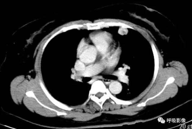 绒毛膜癌转移到脑,绒毛膜癌肺转移