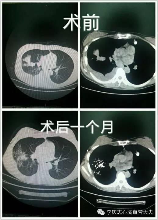 治疗肺癌的“核”*器武**——肺癌放射性粒子植入手术