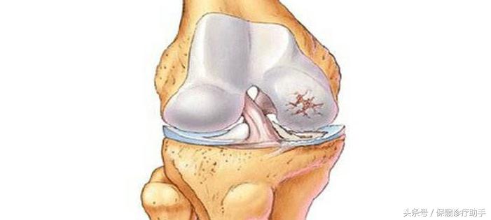 股骨头坏死不治后果是什么,股骨头坏死长期不治有什么后果