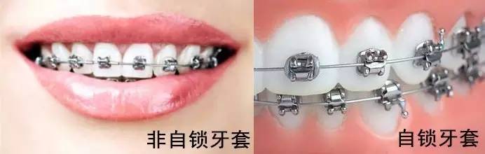 隐形牙套整牙全过程介绍,拔掉四颗牙隐形牙套矫正的全过程