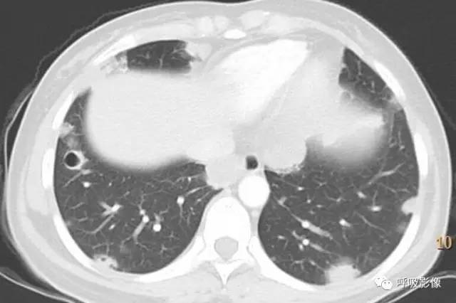 绒毛膜癌转移到脑,绒毛膜癌肺转移