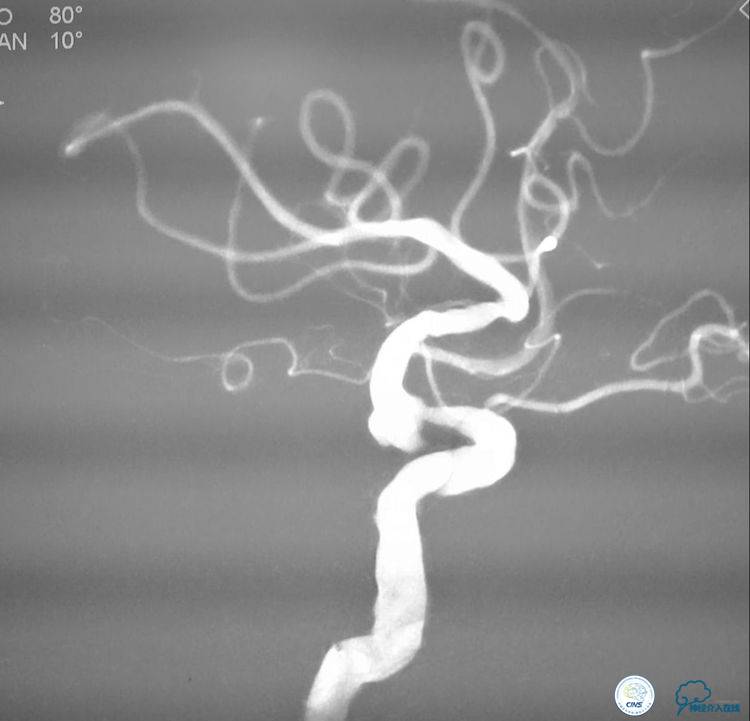 支架辅助弹簧圈栓塞治疗狭窄伴复杂动脉瘤