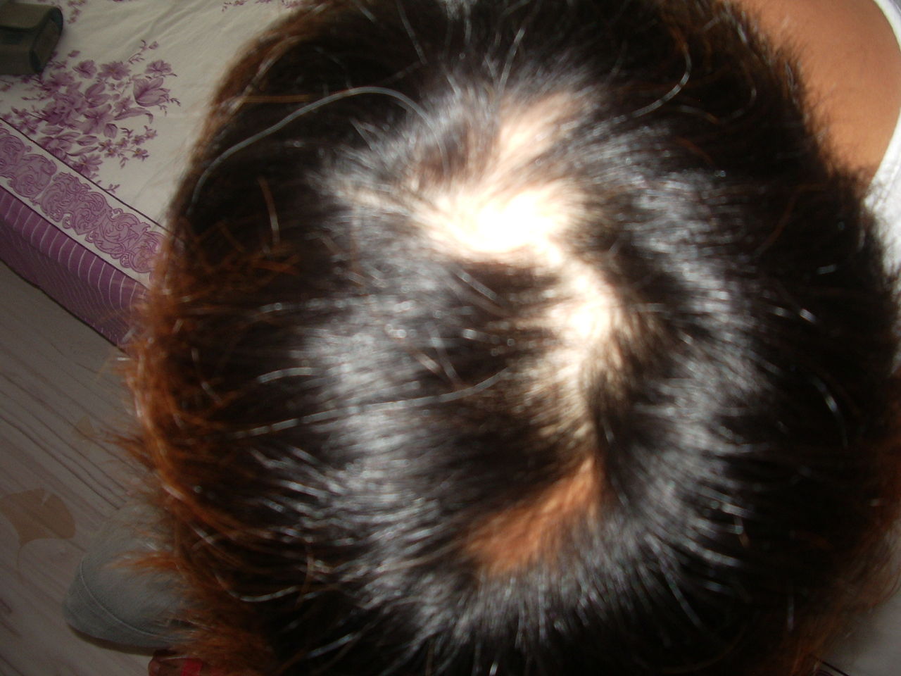 为什么最近老是掉头发呢?|年轻人脱发的七大原因