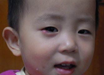 宝宝眼睛红了有事吗,宝宝红眼病眼睛肿怎么办