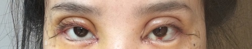 全切双眼皮疤痕增生多久可以恢复,全切双眼皮恢复过程经历真实