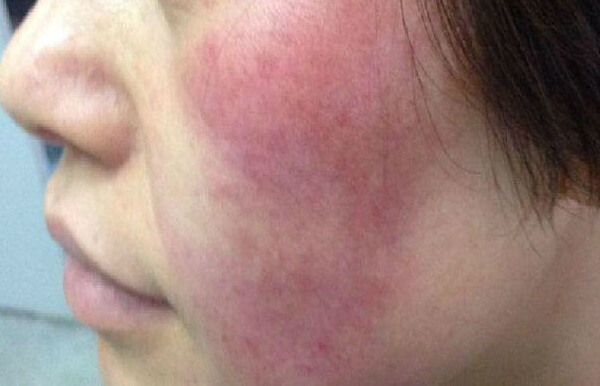 脸上有红血丝怎么缓解,脸上有红血丝怎么修复最快有效