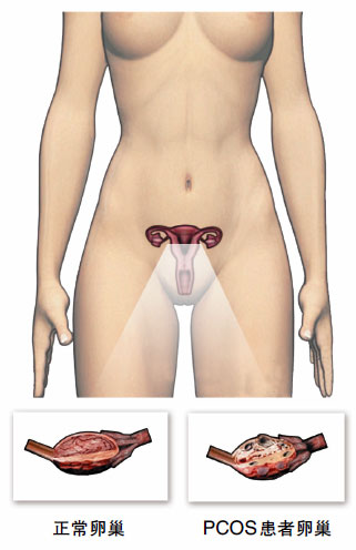 多囊卵巢综合征怎么选择治疗方法,多囊卵巢综合征的症状和解决办法
