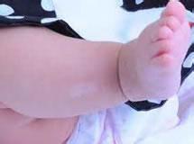 婴幼儿也会得白癜风？是因为遗传吗？
