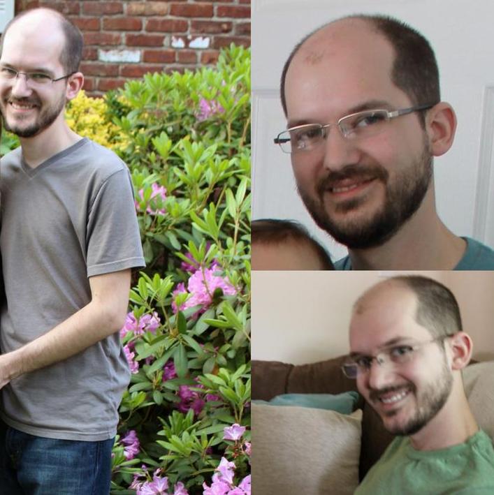 厉害了word的雌性激素，竟然还能拯救大叔的秃顶