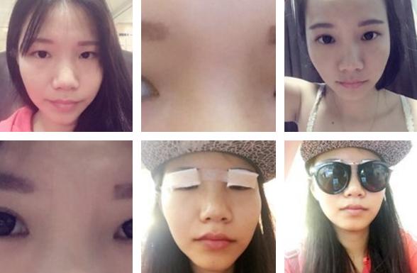 做双眼皮是如何打麻药的,其实做双眼皮没想象中那么疼