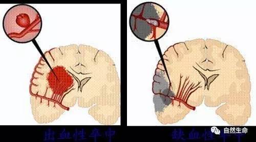 中风了和正常人不一样怎么办,中风证候分型