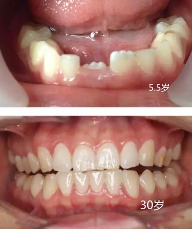 小孩开始换牙了,宝爸宝妈看过来你家宝贝换牙了吗