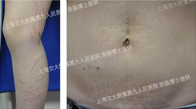 严重的膨胀纹怎么治疗,膨胀纹最好的治疗方法