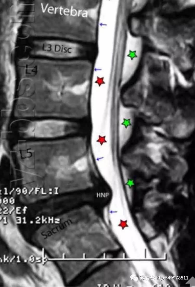 教你如何看腰椎磁共振