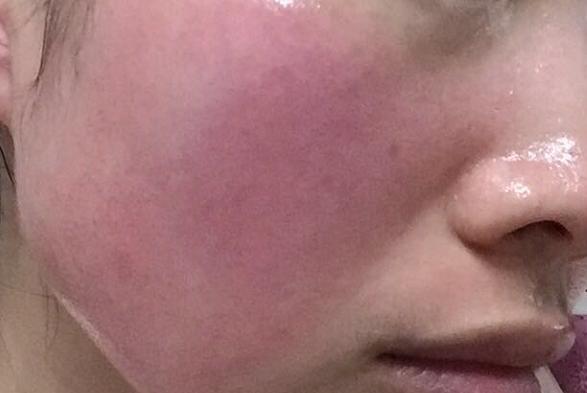 *血丝红**怎么治疗？教你7招祛除*血丝红**