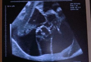 这四种是胎儿的求救信号,孕妈快重视起来!