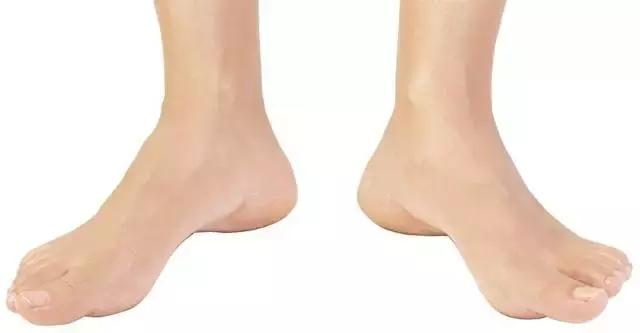 八字脚对跑步有影响吗,跑步时八字脚产生原因及纠正方法