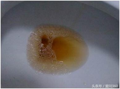 尿液发黄是不是有疾病,尿液发黄代表身体有炎症么