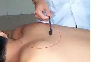 腰突导致腰肌劳损怎么治疗,腰肌劳损的保守治疗方法是什么