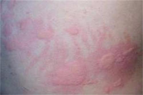 新生儿湿疹热疹宝妈要忌口吗,热痱子和湿疹荨麻疹有什么区别