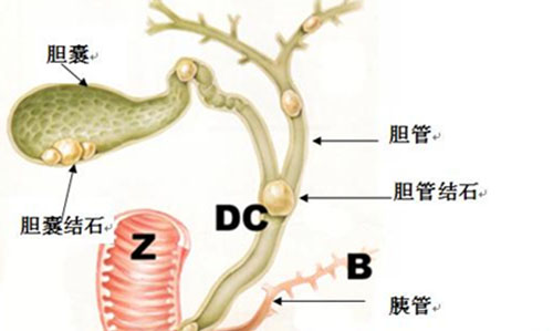 保守治疗胆结石有什么偏方可以治,胆结石有没有偏方治疗
