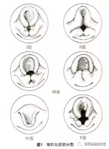 宝宝得喉骨软化症怎么治疗,婴儿喉软化1型能自愈吗