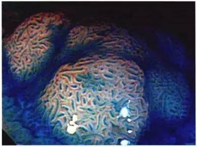 普通内镜与Pitpattern分型（多图详解）