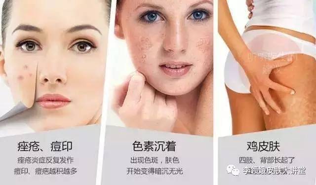 果酸换肤3个月过程,果酸护肤小常识