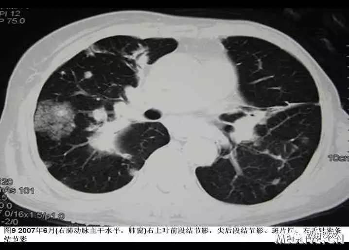 双肺实性小结节考虑炎症肉芽肿,双肺多发恶性肺结节100多个