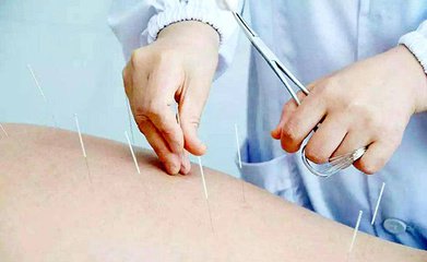 美国医师学会：针灸推荐为治疗急慢性腰痛的唯一一线疗法