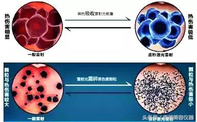 皮秒激光操作视频过程,皮秒为什么会反黑