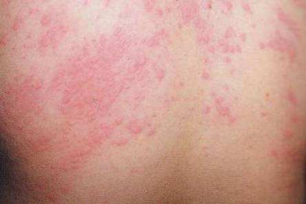 宝宝对牛奶过敏怎么改善体质,怎么改善易过敏体质