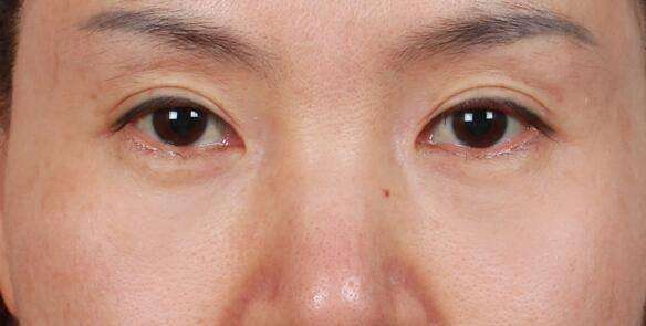 卧蚕与眼袋别傻傻分不清楚,卧蚕眼袋黑眼圈傻傻分不清楚