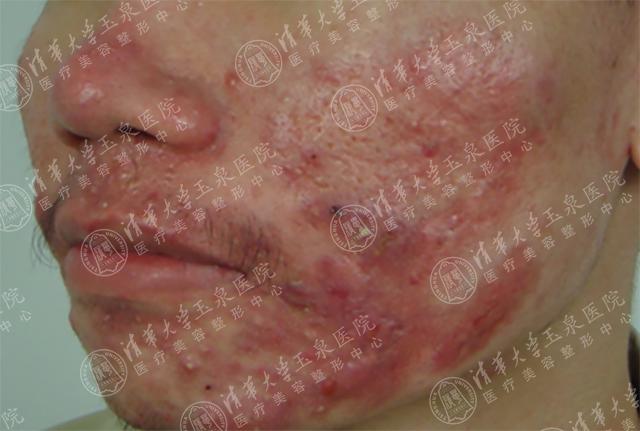 换季疯狂长痘为什么,为什么一到换季皮肤就长痒痘