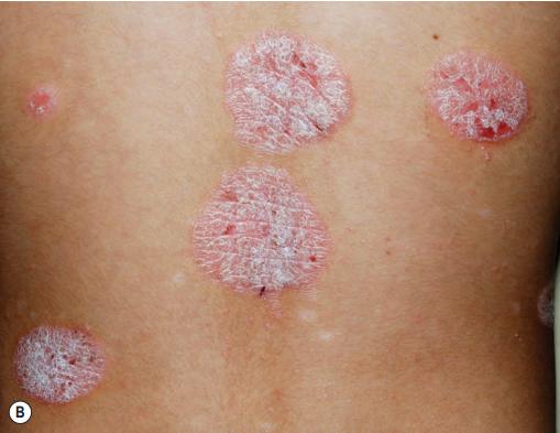 银屑病关节炎和银屑病区别,银屑病关节炎跟银屑病一样吗