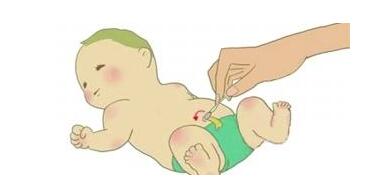 新生儿脐疝怎么护理,小儿脐疝脐带四周会鼓起吗