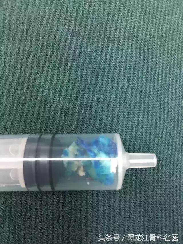 病例分享丨微创疗法让老人远离“腰突”困扰