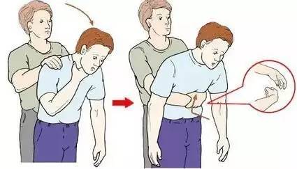 异物卡喉急救中医会怎么救,异物卡喉海姆立克急救法