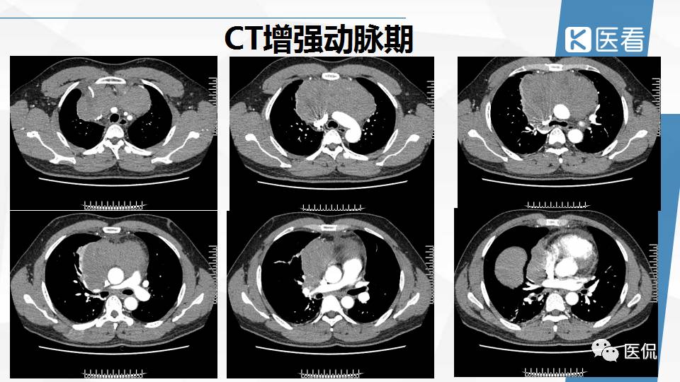 精原细胞瘤ct影像,精原细胞瘤影像特征