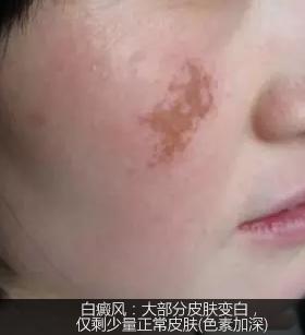 不是白癜风的白斑能查出是什么吗,不是白癜风的白点是啥