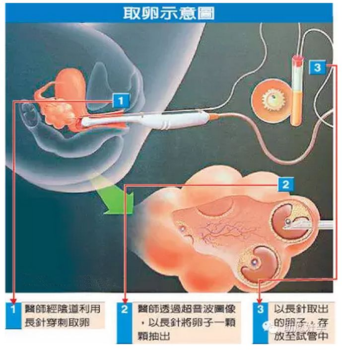 单身女性冻卵事件,单身女性冻卵违法吗