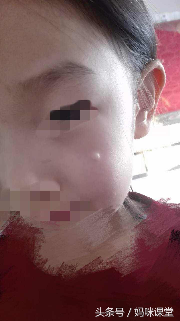 女儿被哥哥家孩子抓伤,4岁女孩被抓伤