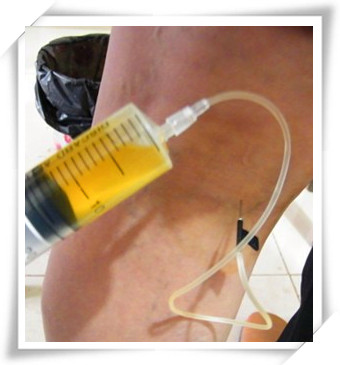 膝关节炎疼痛用什么中草药,老年退化性膝关节炎怎么治疗