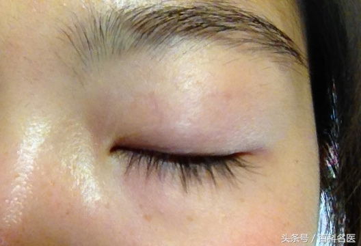 眼角和太阳穴长斑是怎么回事,眼角长斑的原因