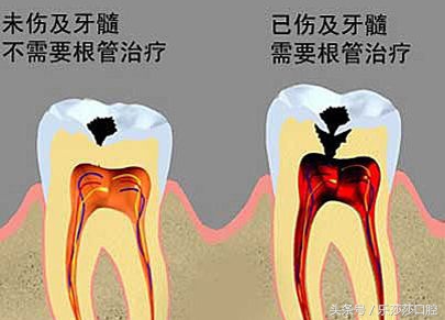 牙齿烂了一个大窟窿可以杀神经吗,牙齿坏了杀神经对身体会有伤害吗