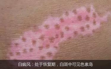 不是白癜风的白斑能查出是什么吗,不是白癜风的白点是啥
