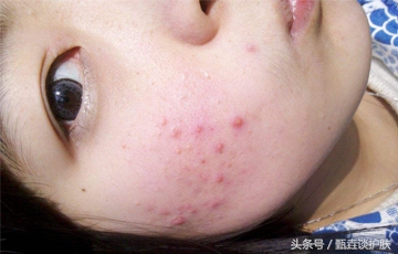 战痘神器推荐,战痘神器